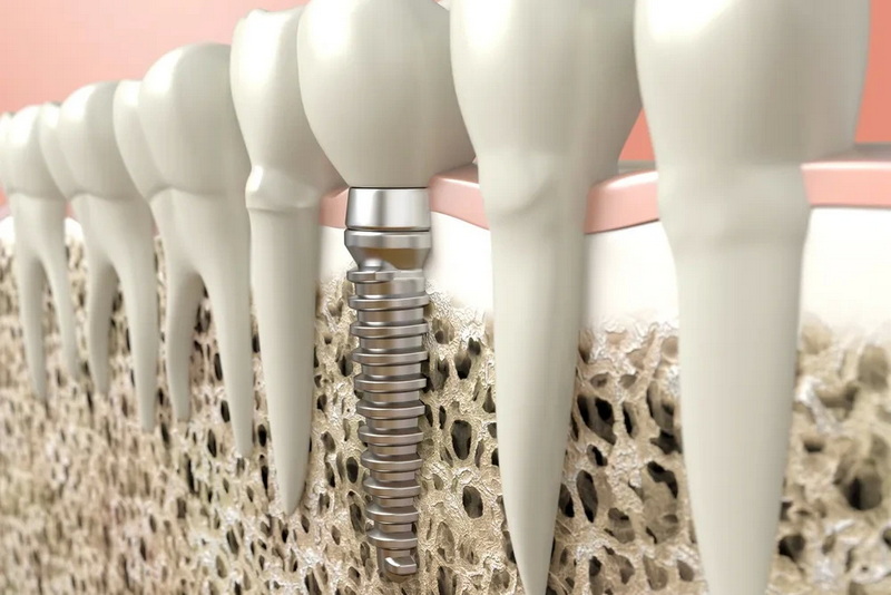 Why Do Dentists Use Healing Abutments Instead of Healing Screws?