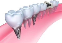 //iirorwxhloqjli5p.ldycdn.com/cloud/loBpkKloljSRillikniqjo/zimmer-healing-abutment.jpg