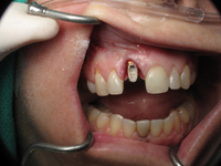 //iirorwxhloqjli5p.ldycdn.com/cloud/loBpkKloljSRilliknqijo/straumann-tissue-level-healing-abutment.jpg