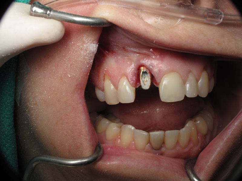 straumann tissue level healing abutment