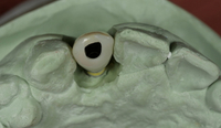//iirorwxhloqjli5p.ldycdn.com/cloud/loBpkKloljSRilliliirjn/implant-abutment-screw-retrieval.jpg
