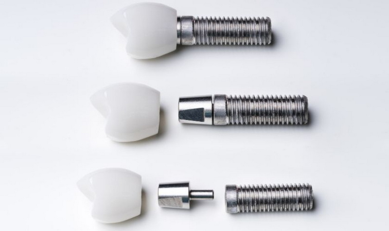 do you need invisalign before a dental implant
