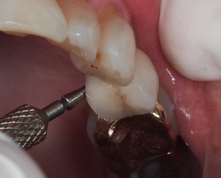 How Does Astra OsseoSpeed EV Healing Abutment Aid In Tissue Healing?