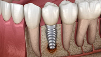 //iirorwxhloqjli5p.ldycdn.com/cloud/loBpkKloljSRilnjmnqkjq/does-a-3-molar-dental-implant-bridge-exist.jpg