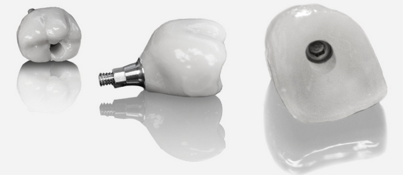 Do You still Probe Around A Dental Implant?