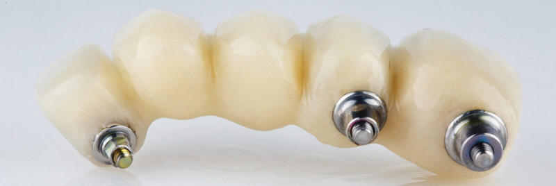 Why Is The Abutment Screw Important In Implant Stability?