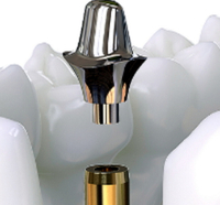 //iirorwxhloqjli5p.ldycdn.com/cloud/loBpkKloljSRilrkrnqojo/straumann-custom-abutment-screw-torque.jpg