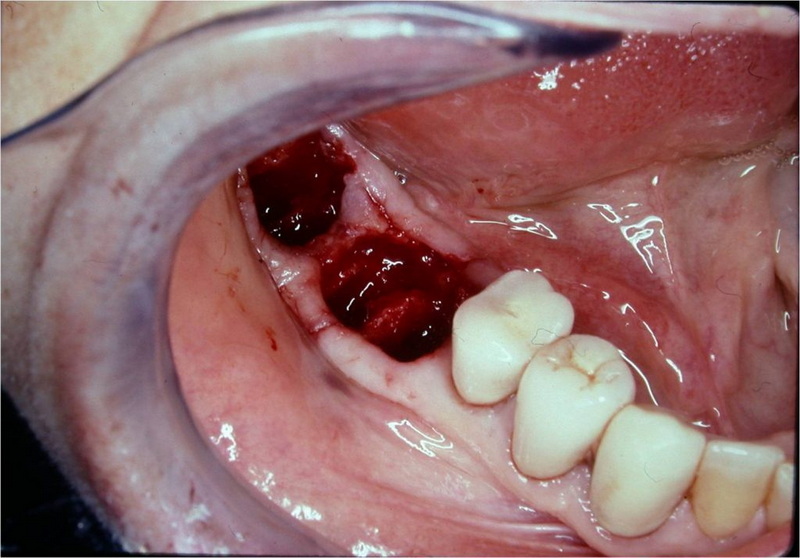 How Much Does A Clearchoice Dental Implant Cost?