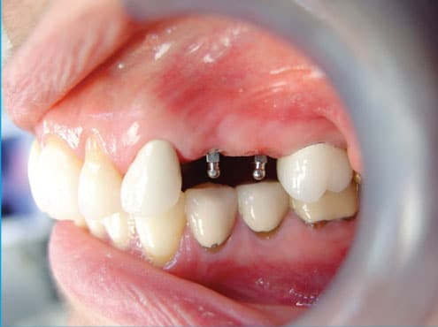 What Is A Mini Dental Implant?