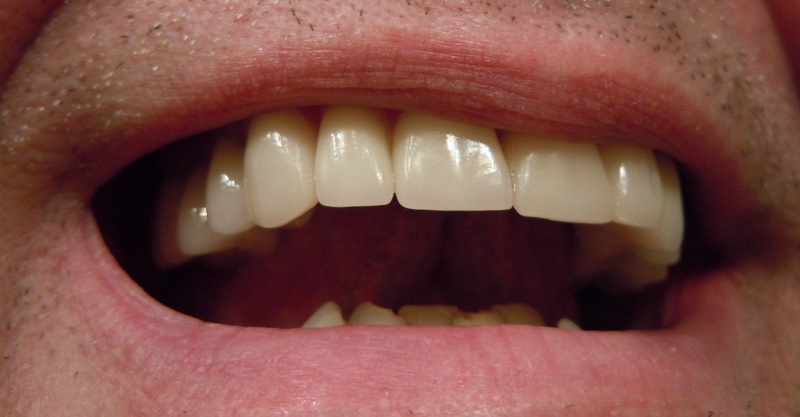how painful is a dental implant post