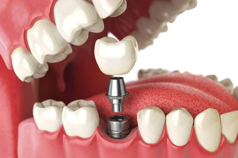 how long after dental implant surgery can i exercise_11