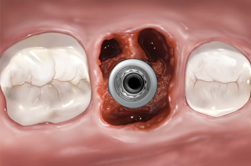 why no dairy after dental implant reddit_2