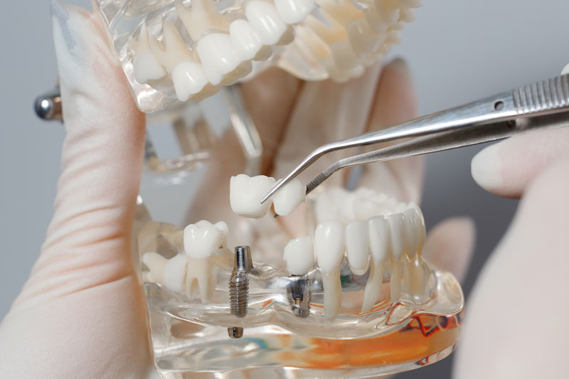 dental implant safe_2