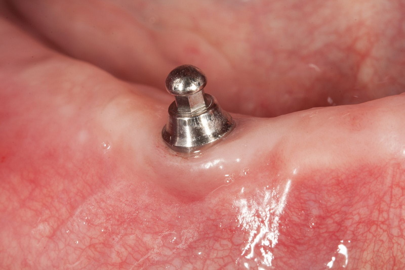 why not to get a dental implant_2