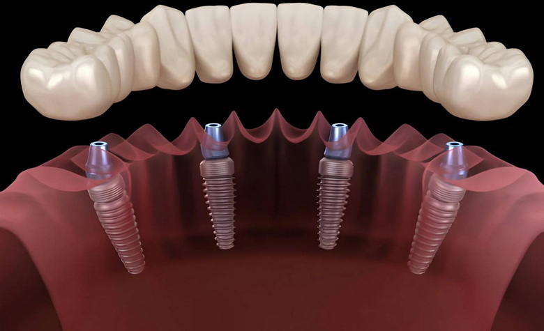 Can A Dental Implant Be Replaced?
