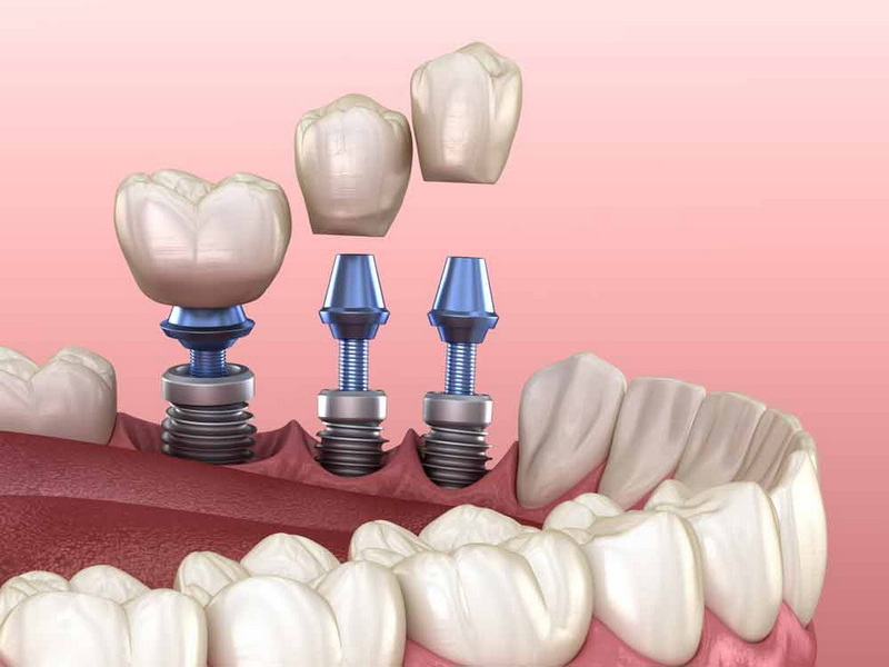 how to stop bleeding after dental implant surgery_3