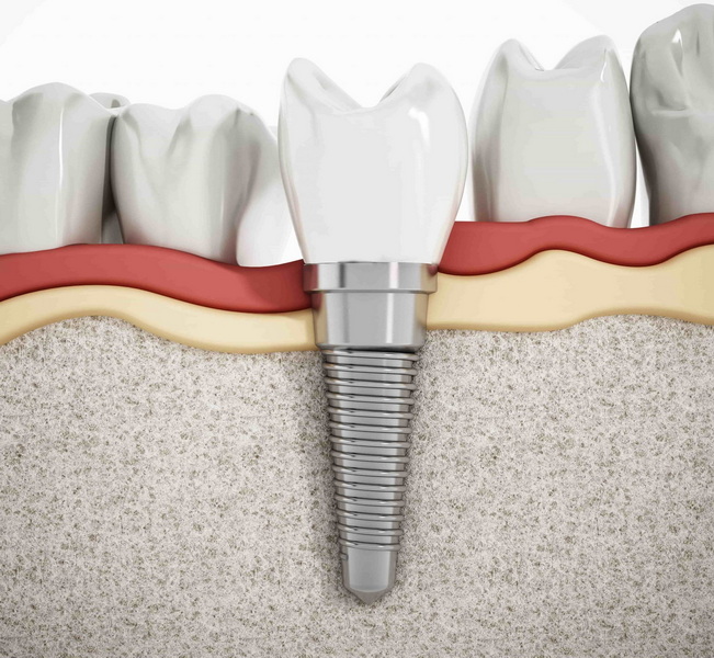 How Bad Does A Dental Implant Hurt?