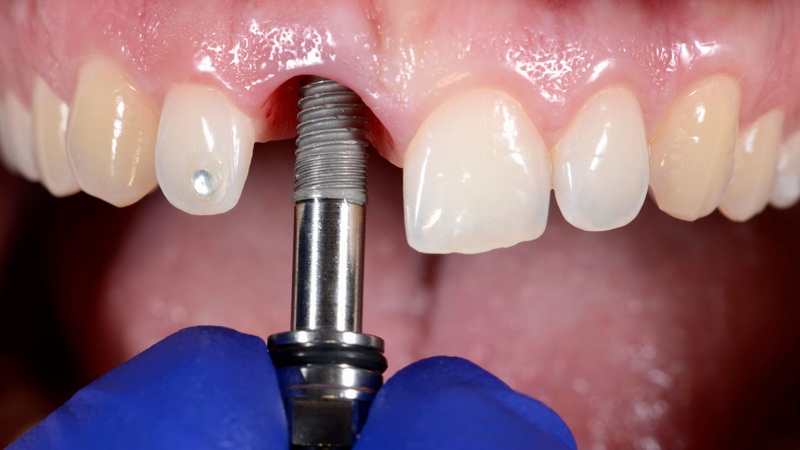 what to do if a dental implant falls out_2