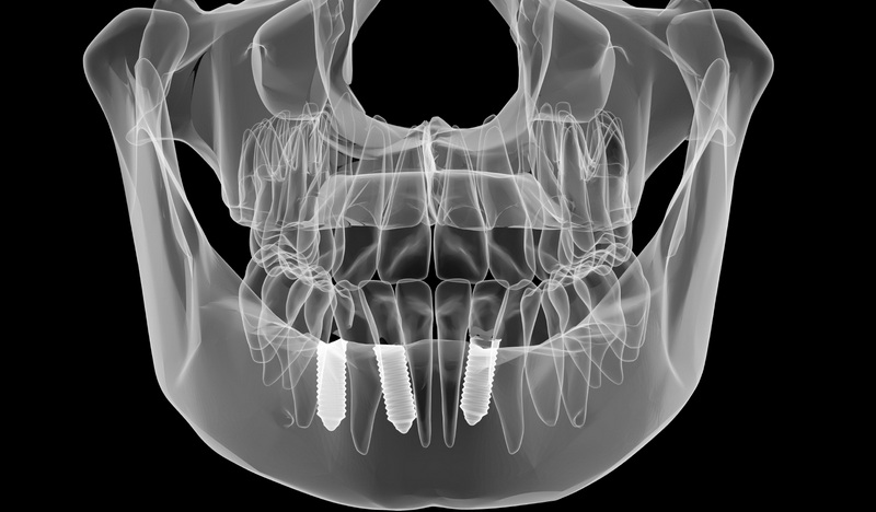  the dental implant commonly fabricated from_1