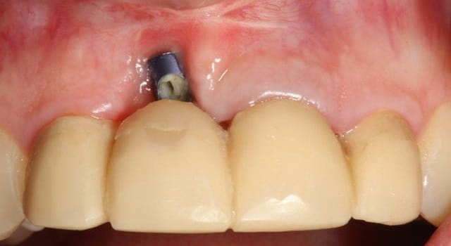 dental implant feel weird_1