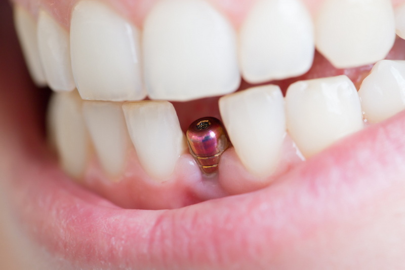 what expect dental implant_3