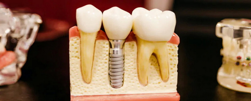 What Is The Lifespan of A Dental Implant?