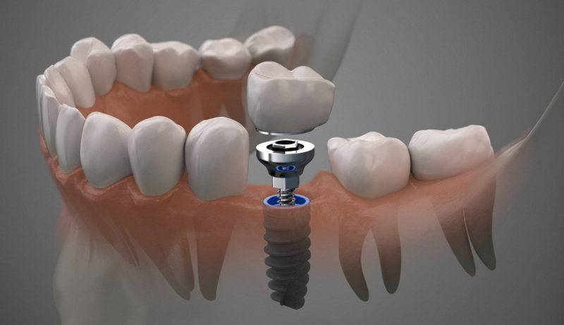 how long does it take to get a dental implant_12