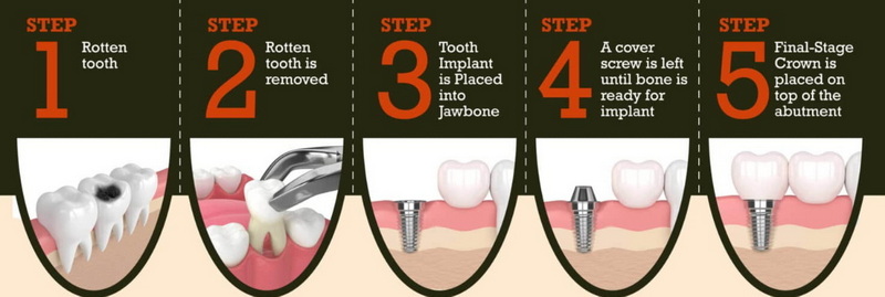 how is a dental implant done_19