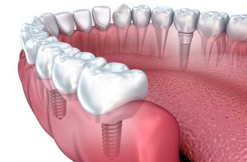 what happens after dental implant_2
