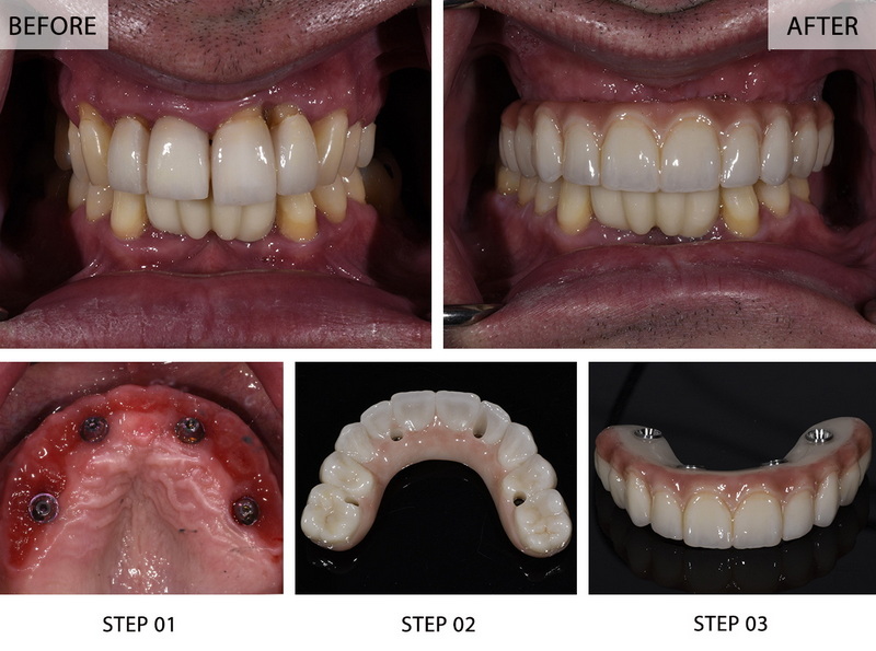 a failed dental implant feel like_1