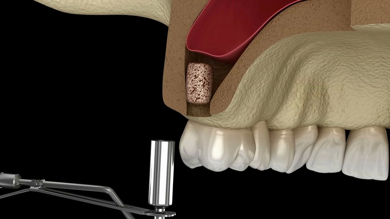 Is Dental Implant A Major Surgery?