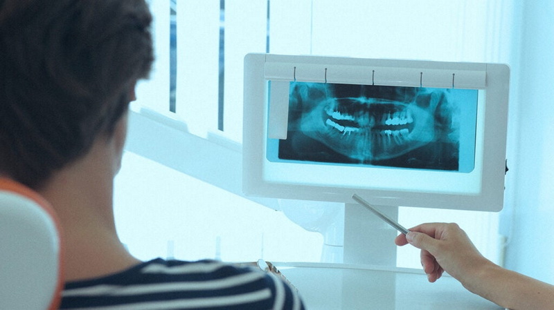 Should My Dental Implant Be Exposed?