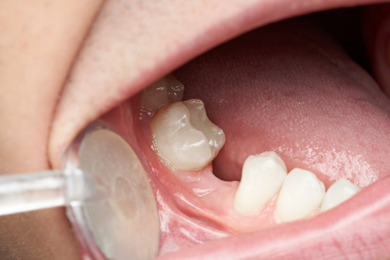What Happens If Your Dental Implant Fails?