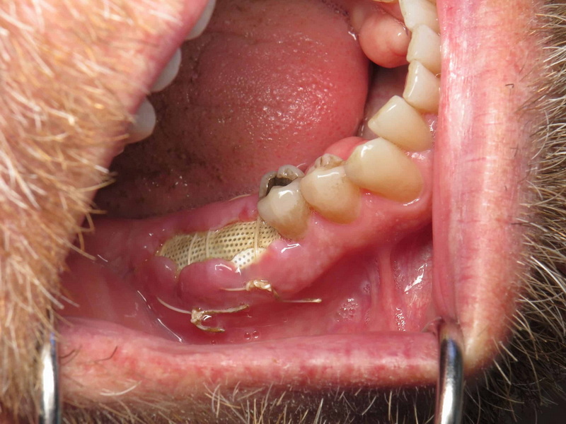 How Long Is Dental Implant Recovery?