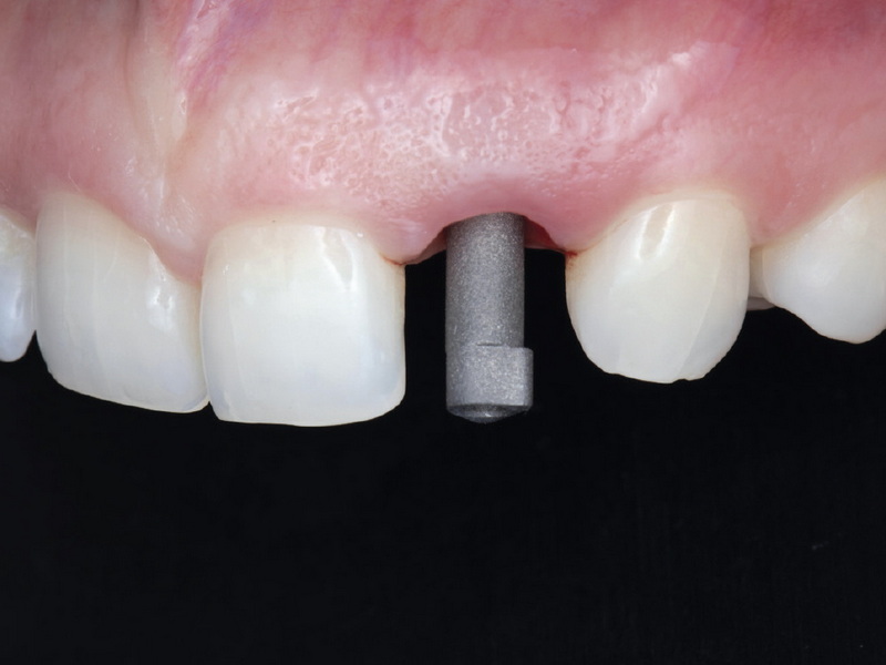 how long to have a healing abutment_2