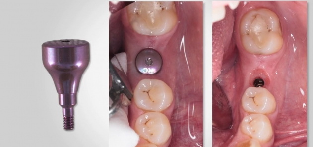 how long can you have a healing abutment_2