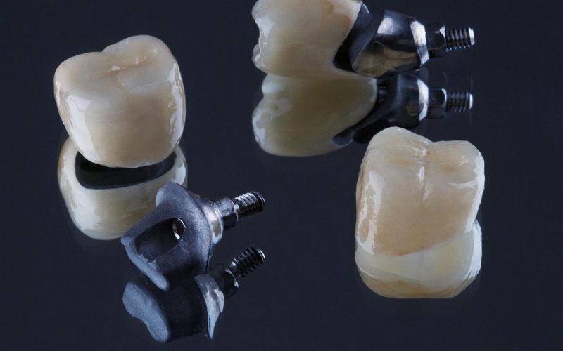 Are There Affordable Options for Dental Abutments?