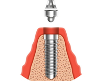 //iirorwxhloqjli5p.ldycdn.com/cloud/loBpkKloljSRrljkjmkkjo/nobel-healing-abutment.jpg