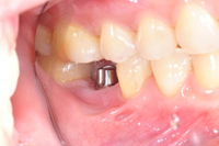 //iirorwxhloqjli5p.ldycdn.com/cloud/loBpkKloljSRrljkjmljjo/neodent-healing-abutment.jpg