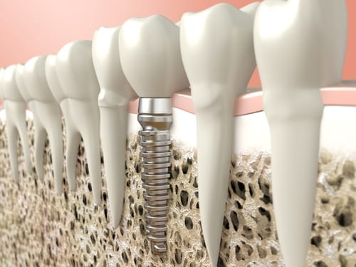 What Happens If You Choose The Wrong Healing Abutment Size?