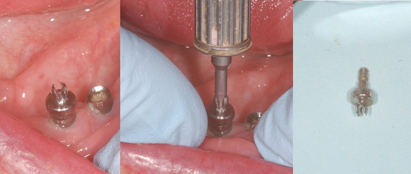 Why Do Some Implants Have Cover Screws And Others Healing Abutments?