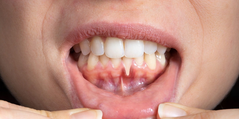 can exercise cause pain after dental implant