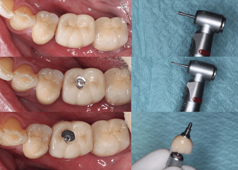 biohorizons abutment screw