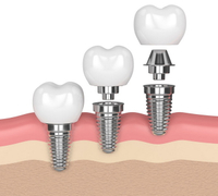 //iirorwxhloqjli5p.ldycdn.com/cloud/loBpkKloljSRrllnllmojq/dental-abutment-for-post-implant.jpg
