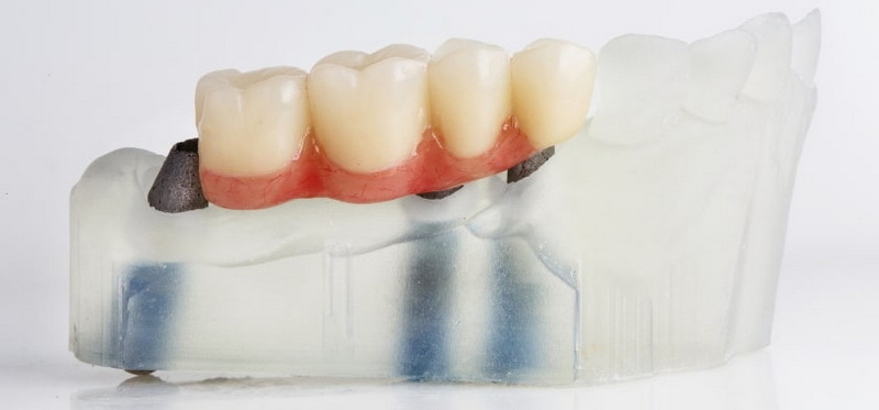 Is An NC Healing Abutment Compatible with Other Implant Systems?