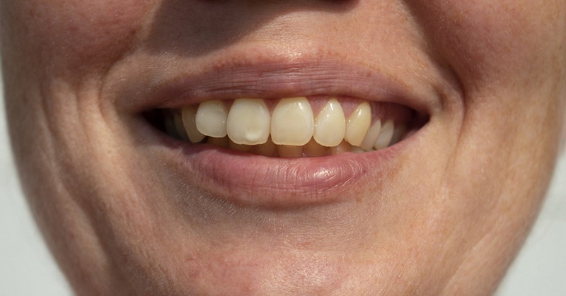 Can We Doing Dental Implant Right Away?