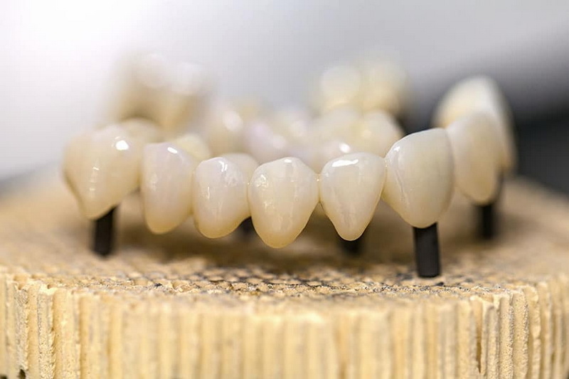 dental abutment bridge