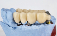 //iirorwxhloqjli5p.ldycdn.com/cloud/loBpkKloljSRrlmlojpkjq/dental-abutment-came-out.jpg