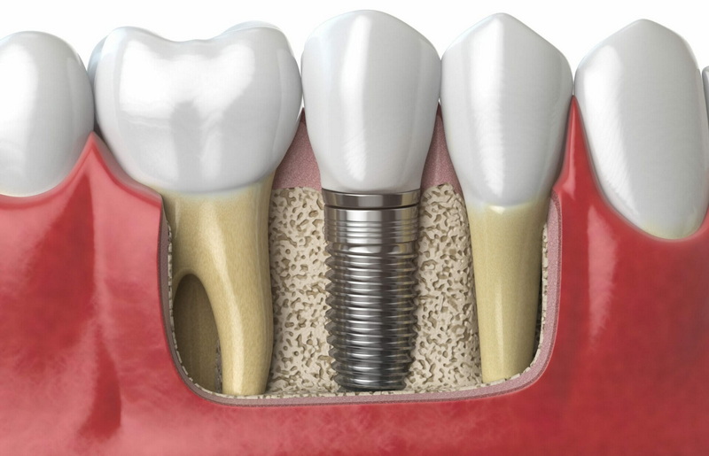 solid body dental abutment and crown for implant