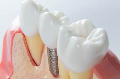 Can I Chew After Dental Implant?